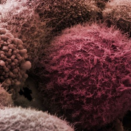 Major insight into killer pancreatic cancer