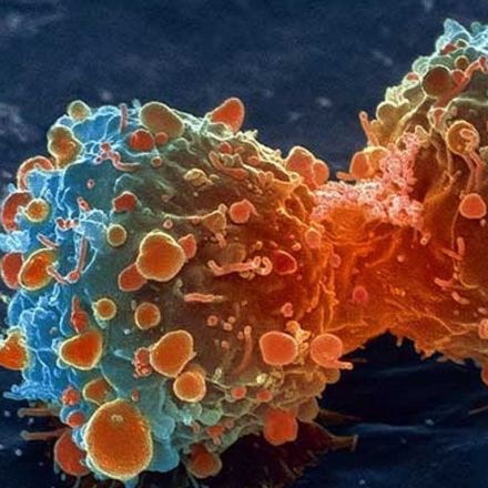Terminal cancer patients in complete remission after one gene therapy treatment 