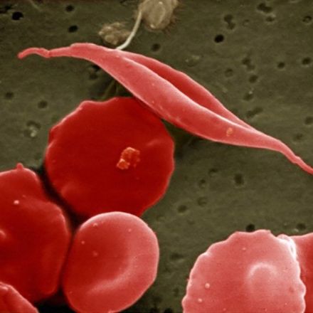 Gene therapy to fight a blood cancer succeeds in major study