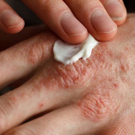 Scientists Have Discovered What Really Happens in The Skin When You Have Eczema