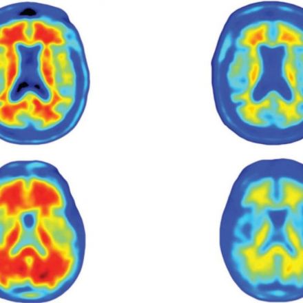 New Alzheimer's drug gives hope after breakthrough trials