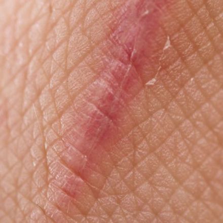 Scientists have figured out how to make wounds heal without scars.
