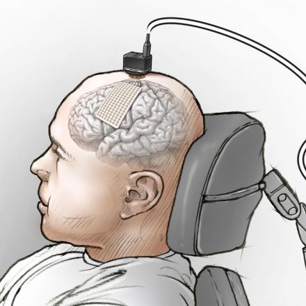 Brain implants let paralyzed man with severe speech loss 'speak' again