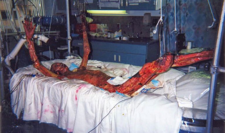 Hiroshi Ouchi after his skin fell off due to radiation destroying his chromosomes,
