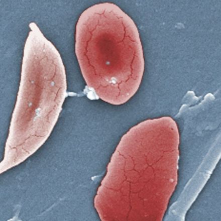 Everyone with the sickle cell gene mutation descended from the same ancestor 7,300 years ago
