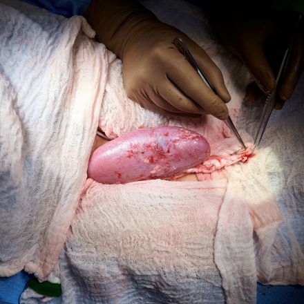 U.S. surgeons successfully test pig kidney transplant in human patient