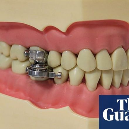 New weight-loss tool prevents mouth from opening more than 2mm