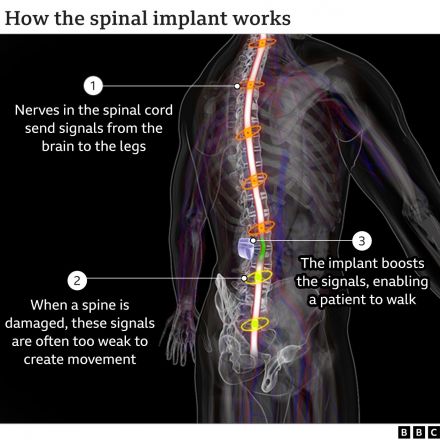 Paralysed man with severed spine walks thanks to implant