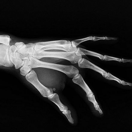 Custom-Made Bones Are Being 3D Printed in a Lab Then Implanted in People
