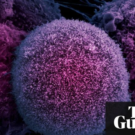 Prostate cancer breakthrough as UK team develops more accurate test