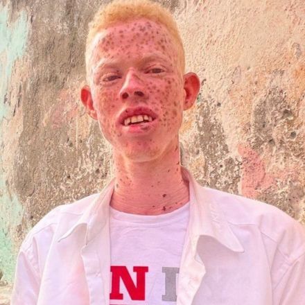 Somalis with albinism: Pelted with stones and raw eggs