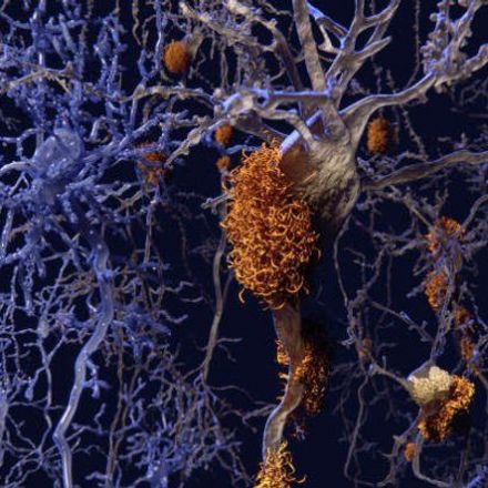 The Case for Transmissible Alzheimer's Grows