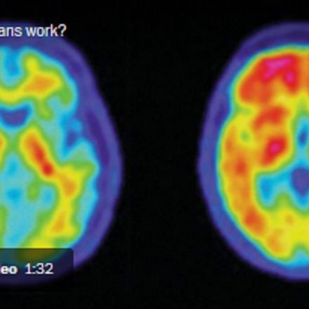 PET scans show many Alzheimer’s patients may not actually have the disease