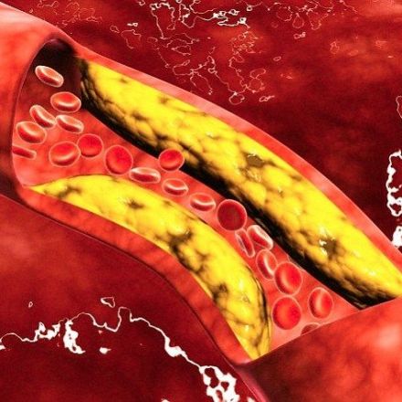 Drug 'melts away' fat inside arteries