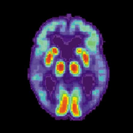 Artificial Intelligence Can Detect Alzheimer’s Disease in Brain Scans Six Years Before a Diagnosis