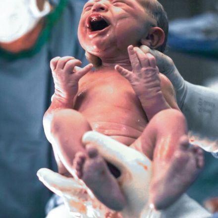The troubling epidemic of unnecessary C-sections around the world, explained