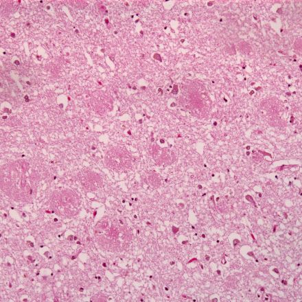 Stem cells shed light on potential anti-Alzheimer’s compound