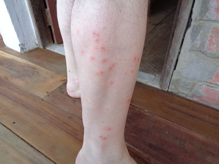 Eaten alive! This is after only a few hours after arriving in Puerto Cayo, Ecuador.  <br />
The mosquitoes LOVE fresh, exotic flesh to dine upon.