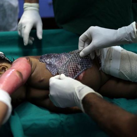 An experimental treatment: Doctors in Brazil use fish skin to treat burn victims
