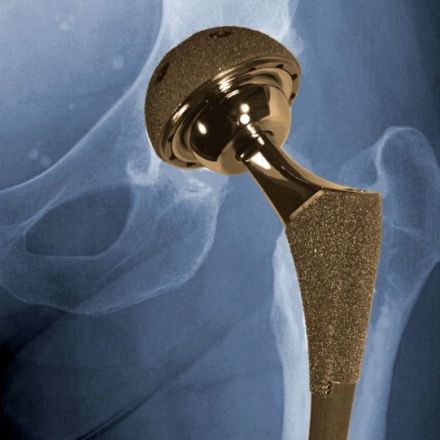 Digital driven printer develops bone replacements