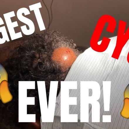 Popping the BIGGEST CYST EVER!
