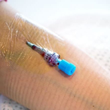 Patients jabbed in the wrong places: botched, painful catheters rife