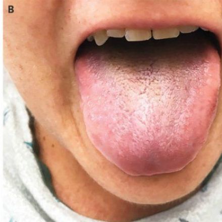 A Rare Case of Black Hairy Tongue Has Been Recorded in The US
