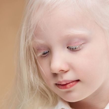 What if all humans on Earth had albinism?