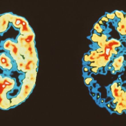 ‘Landmark study’ shows brain cells revamp their DNA, perhaps sparking Alzheimer’s disease