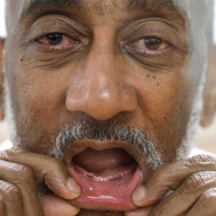 Toothless Texas inmates denied dentures in state prison