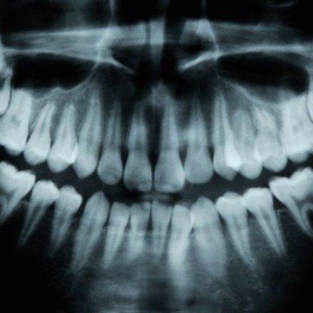 An Alzheimer's Drug Has Been Found to Help Teeth Repair Themselves in Just 6 Weeks