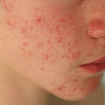 Genetic study of people with acne raises prospect of new treatment
