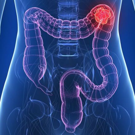 Why Are More Young Americans Getting Colon Cancer?