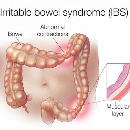 First image of an irritable bowel