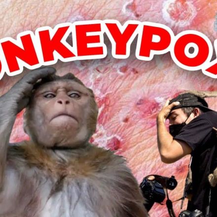 Monkeypox? A Doctor Explains