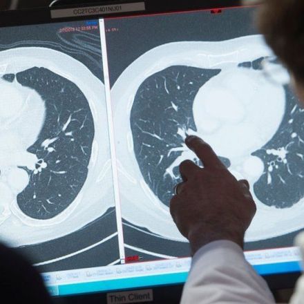 US cancer death rate drops by 30% since 1991